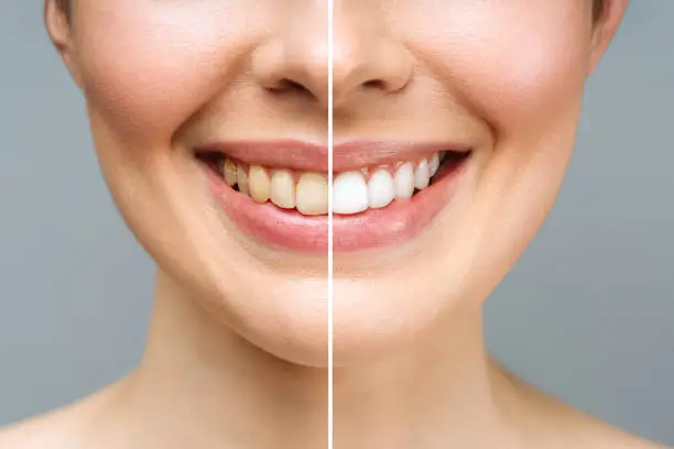 Whitening image